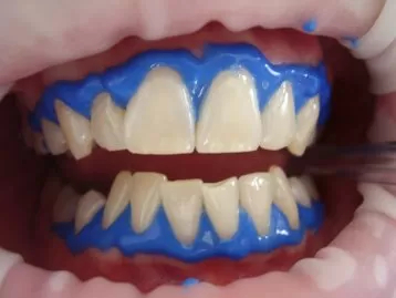 zobu balinasana ar lazeri