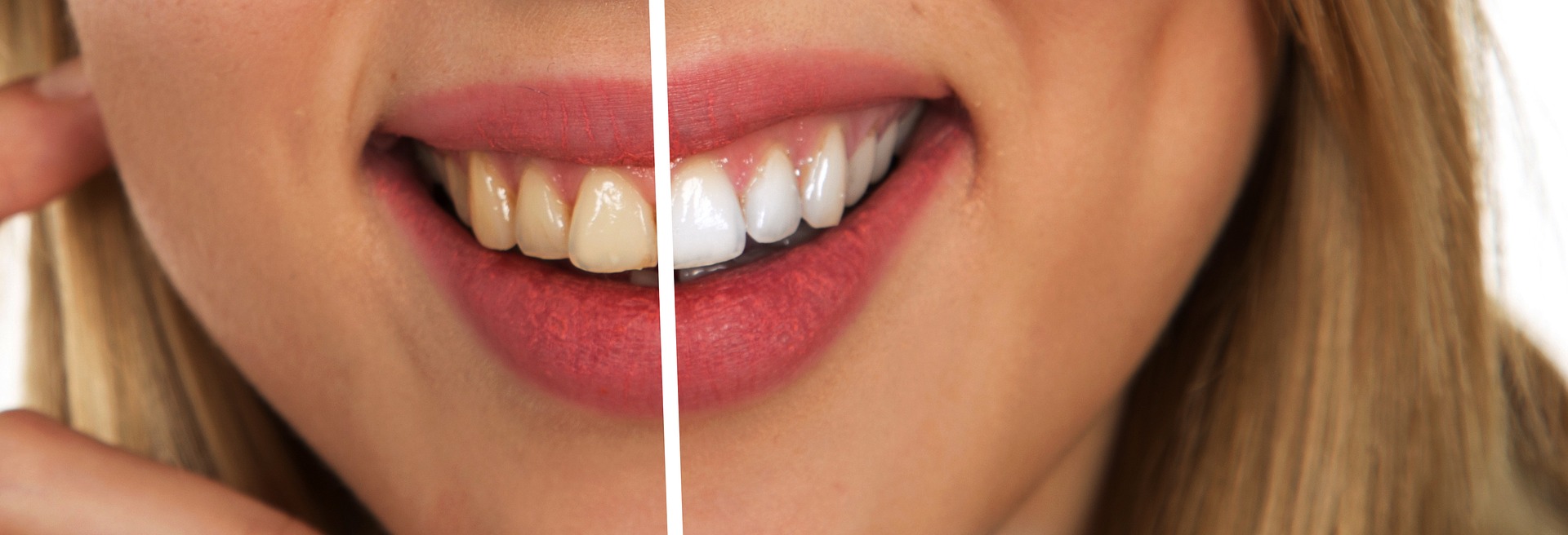 Dzelteni zobi: kādi ir iemesli un kā tos padarīt baltākus