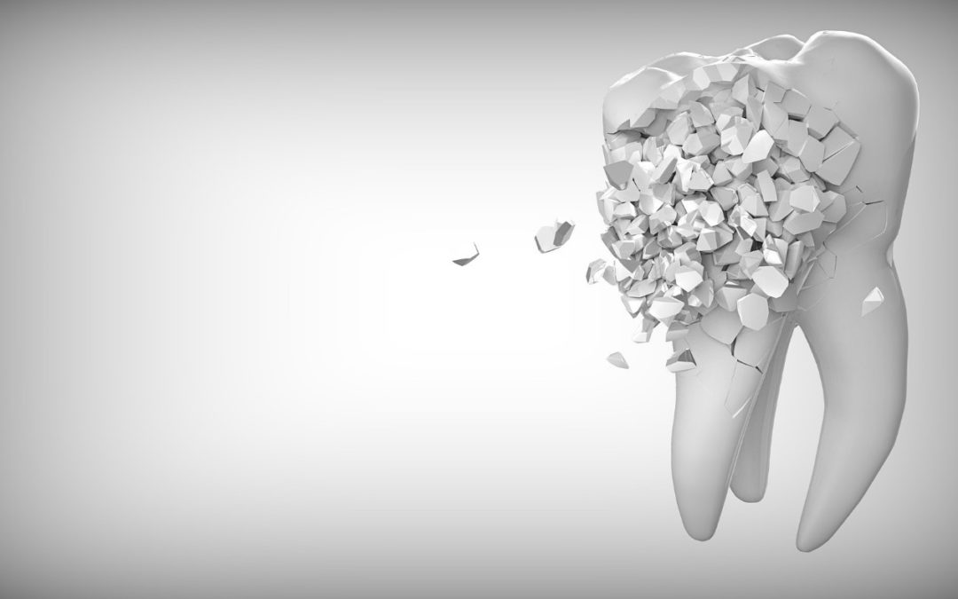 6 svarīgi iemesli, kāpēc jāaizstāj zaudētie zobi